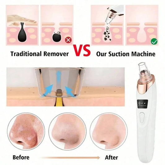 Electric Blackhead Remover (Pore Cleaning Device)